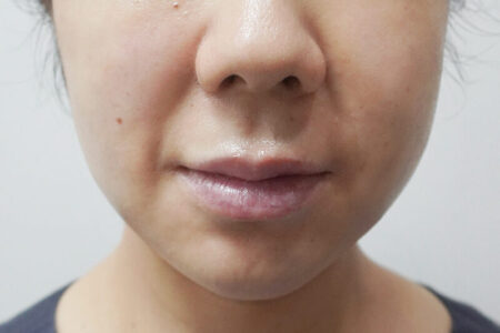 幹細胞皮膚注射