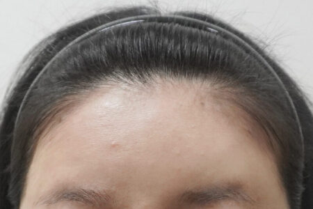 額フィラー (ベベフィル)