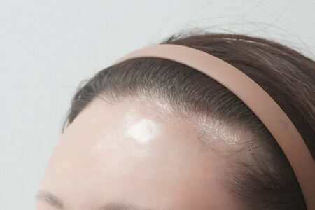 額フィラー (ベベフィル)