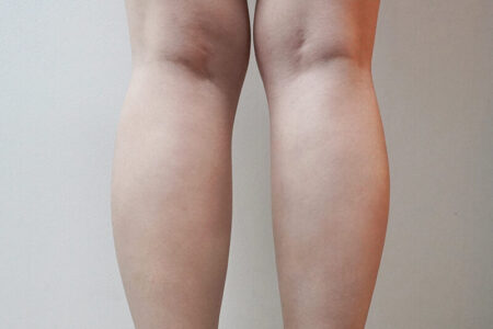 ふくらはぎボトックス