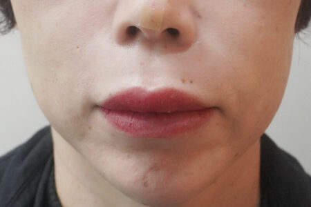 ほうれい線フィラー