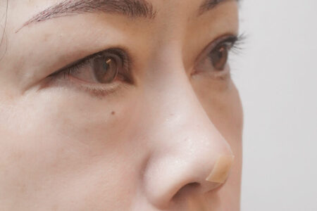 ハイコフィラー