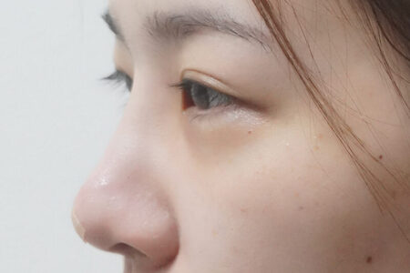 ハイコフィラー