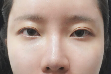 こめかみフィラー + ハイコフィラー