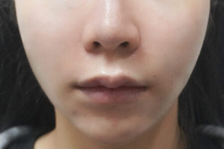 中顔面短縮リフト + ほうれい線フィラー