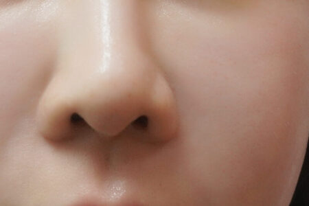 エクソスマート幹細胞施術